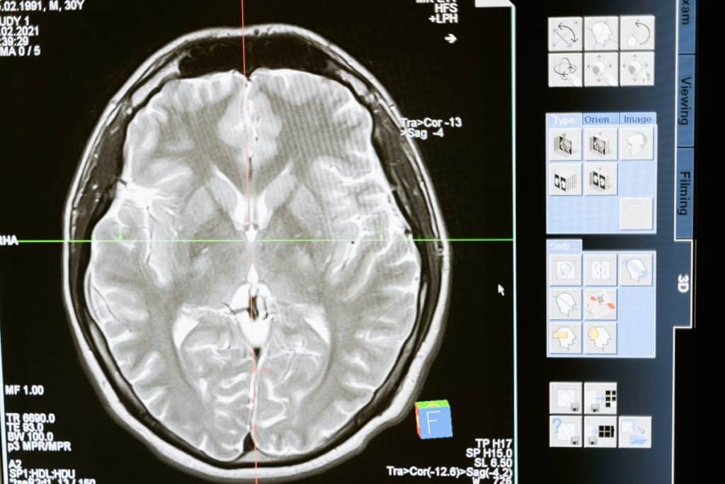 How the Brain Changes During Recovery