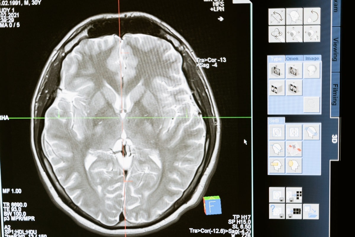 How the Brain Changes During Recovery
